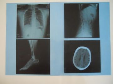 KND-A ฟิล์มหมอกแห้งทางการแพทย์สำหรับการตรวจ X-ray บน AGFA 5300/5302/5500